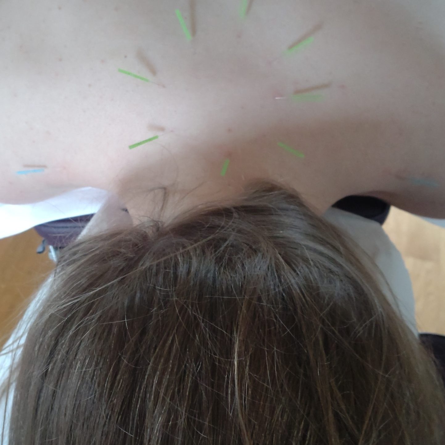 Tässä hoidetaan asiakkaalle muodostunutta niskan ja yläselän liittymän kohdalle muodostunutta pullistumaa